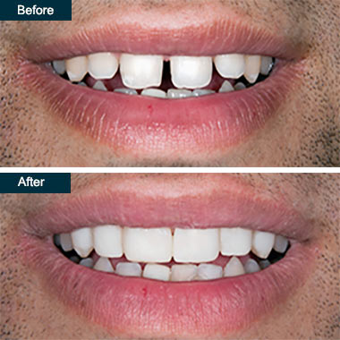 Cosmetic Dental Bonding- Teeth Bonding in Yonkers, NY